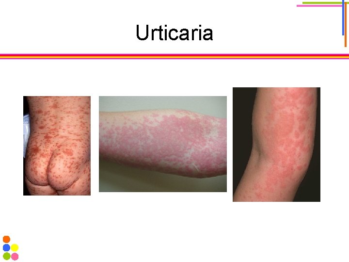 Urticaria 