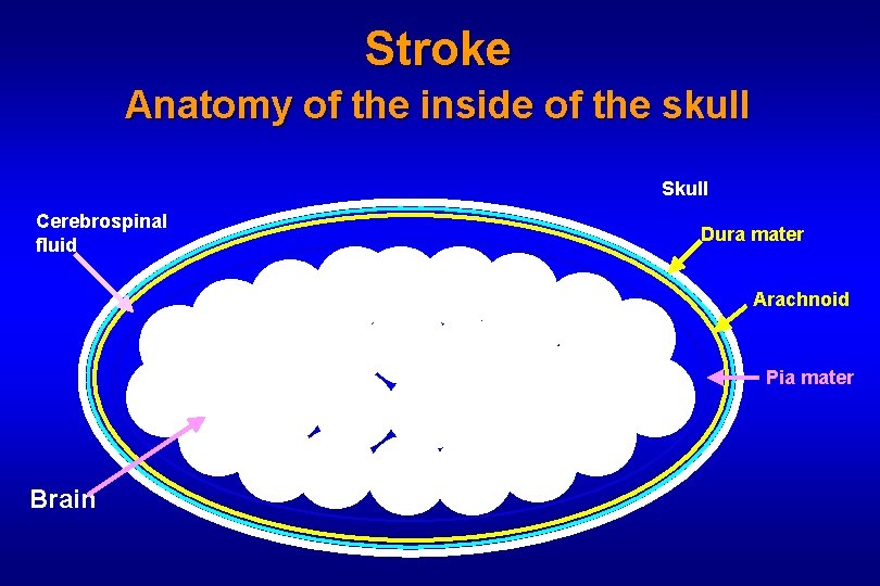 Stroke Anatomy of the inside of the skull Skull Cerebrospinal fluid Dura mater Arachnoid