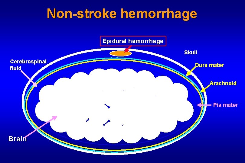 Non-stroke hemorrhage Epidural hemorrhage Skull Cerebrospinal fluid Dura mater Arachnoid Pia mater Brain 