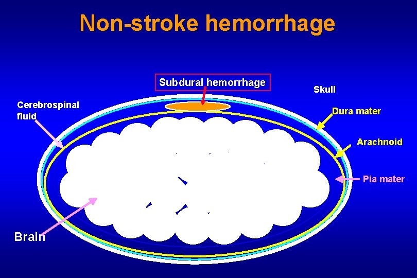 Non-stroke hemorrhage Subdural hemorrhage Cerebrospinal fluid Skull Dura mater Arachnoid Pia mater Brain 