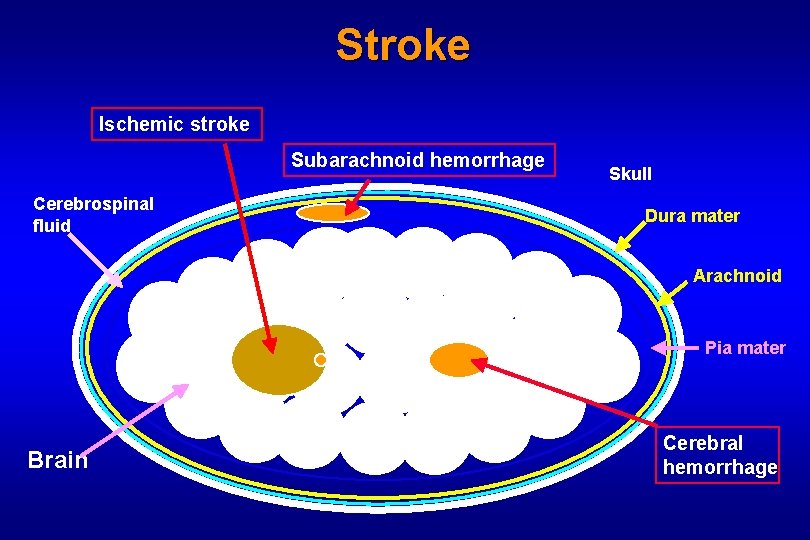 Stroke Ischemic stroke Subarachnoid hemorrhage Cerebrospinal fluid Skull Dura mater Arachnoid Pia mater Brain