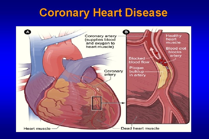 Coronary Heart Disease 