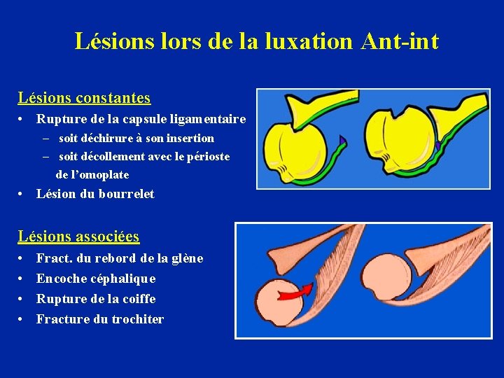 Lésions lors de la luxation Ant-int Lésions constantes • Rupture de la capsule ligamentaire