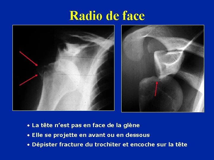 Radio de face • La tête n’est pas en face de la glène •