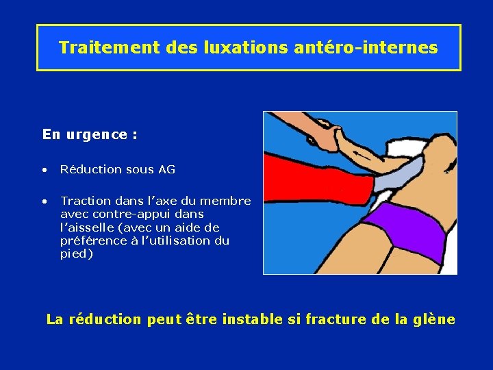 Traitement des luxations antéro-internes En urgence : • Réduction sous AG • Traction dans