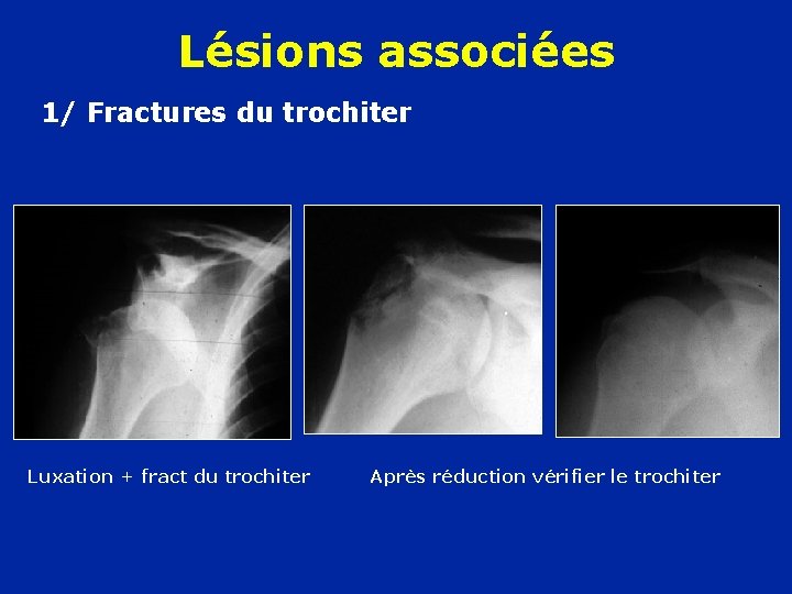 Lésions associées 1/ Fractures du trochiter Luxation + fract du trochiter Après réduction vérifier