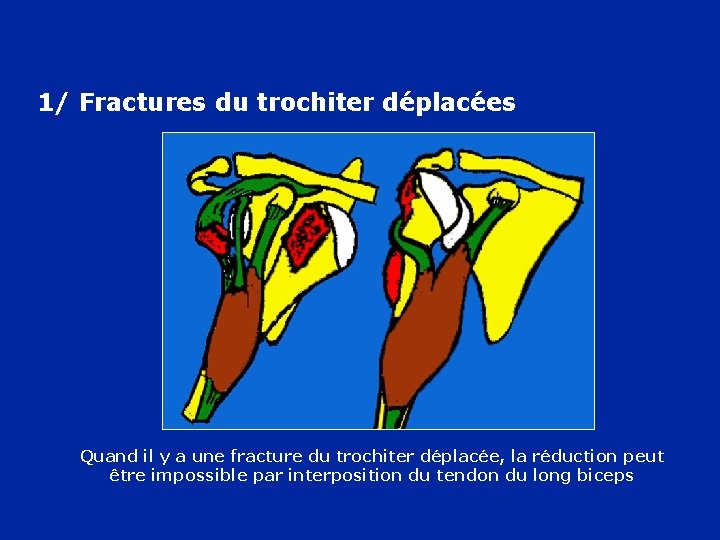 1/ Fractures du trochiter déplacées Quand il y a une fracture du trochiter déplacée,