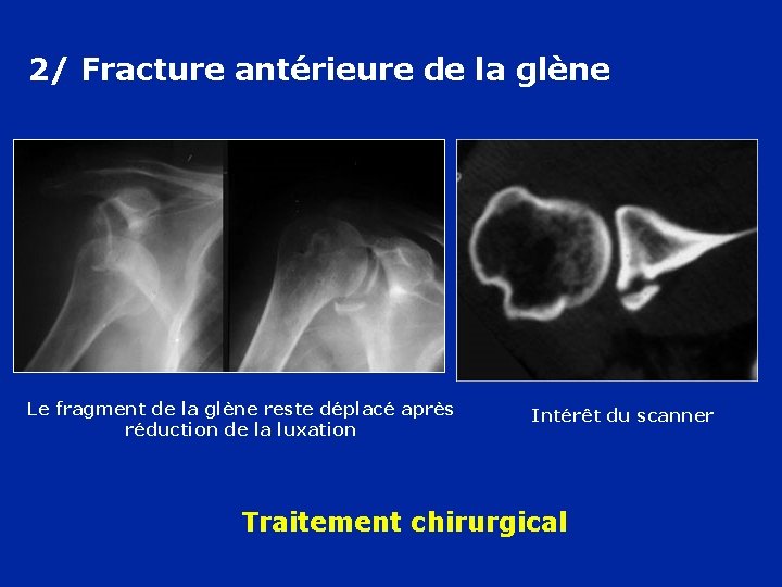 2/ Fracture antérieure de la glène Le fragment de la glène reste déplacé après