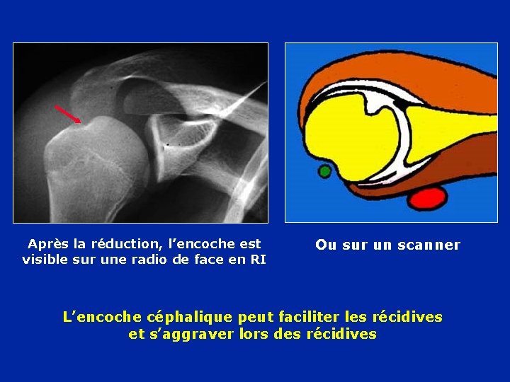 Après la réduction, l’encoche est visible sur une radio de face en RI Ou