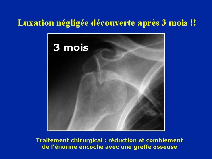 Luxation négligée découverte après 3 mois !! 3 mois Traitement chirurgical : réduction et