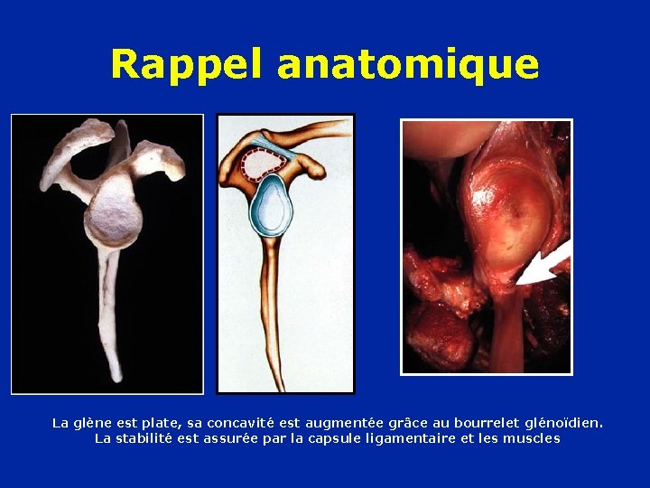 Rappel anatomique La glène est plate, sa concavité est augmentée grâce au bourrelet glénoïdien.