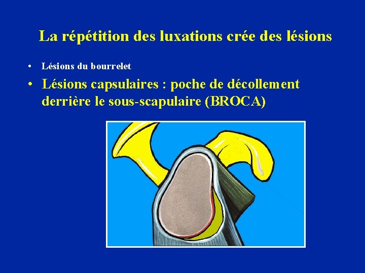 La répétition des luxations crée des lésions • Lésions du bourrelet • Lésions capsulaires