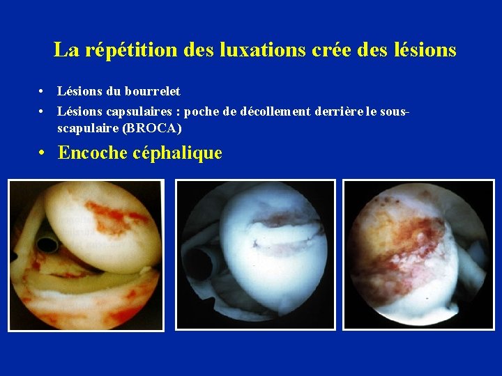 La répétition des luxations crée des lésions • Lésions du bourrelet • Lésions capsulaires