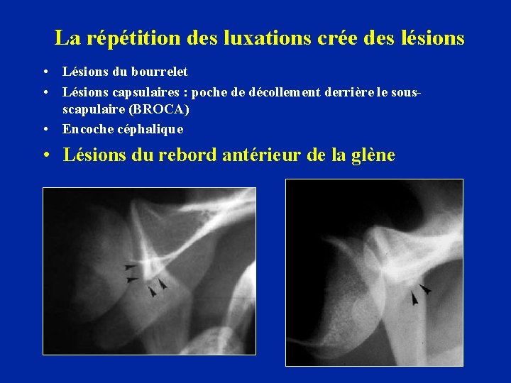 La répétition des luxations crée des lésions • Lésions du bourrelet • Lésions capsulaires