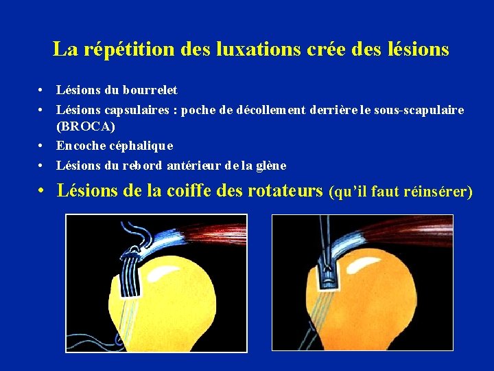 La répétition des luxations crée des lésions • Lésions du bourrelet • Lésions capsulaires