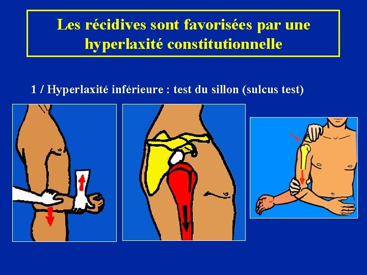 Les récidives sont favorisées par une hyperlaxité constitutionnelle 1 / Hyperlaxité inférieure : test