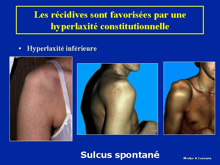 Les récidives sont favorisées par une hyperlaxité constitutionnelle • Hyperlaxité inférieure Sulcus spontané Photos