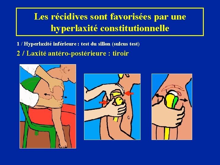 Les récidives sont favorisées par une hyperlaxité constitutionnelle 1 / Hyperlaxité inférieure : test