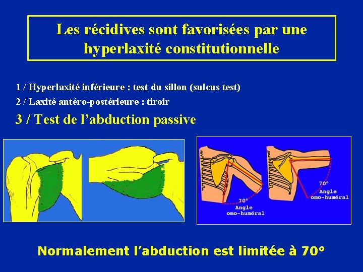 Les récidives sont favorisées par une hyperlaxité constitutionnelle 1 / Hyperlaxité inférieure : test