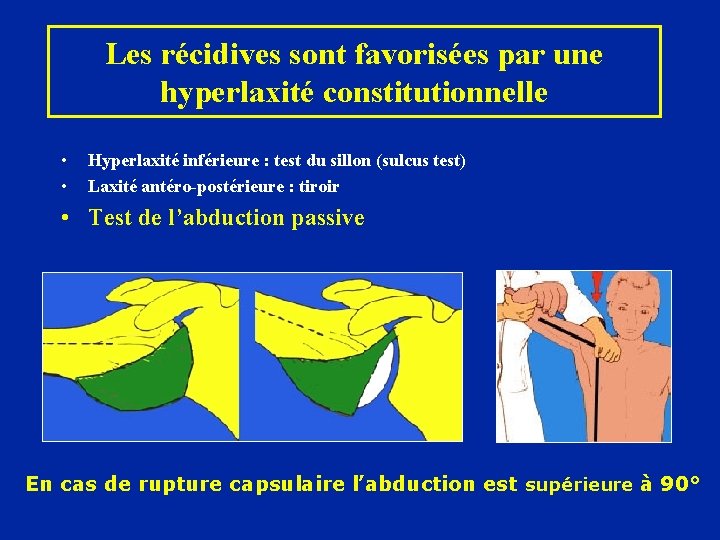 Les récidives sont favorisées par une hyperlaxité constitutionnelle • • Hyperlaxité inférieure : test