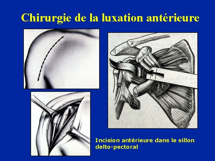 Chirurgie de la luxation antérieure Incision antérieure dans le sillon delto-pectoral 