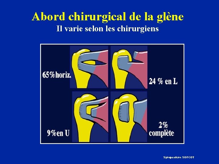Abord chirurgical de la glène Il varie selon les chirurgiens Symposium SOFCOT 