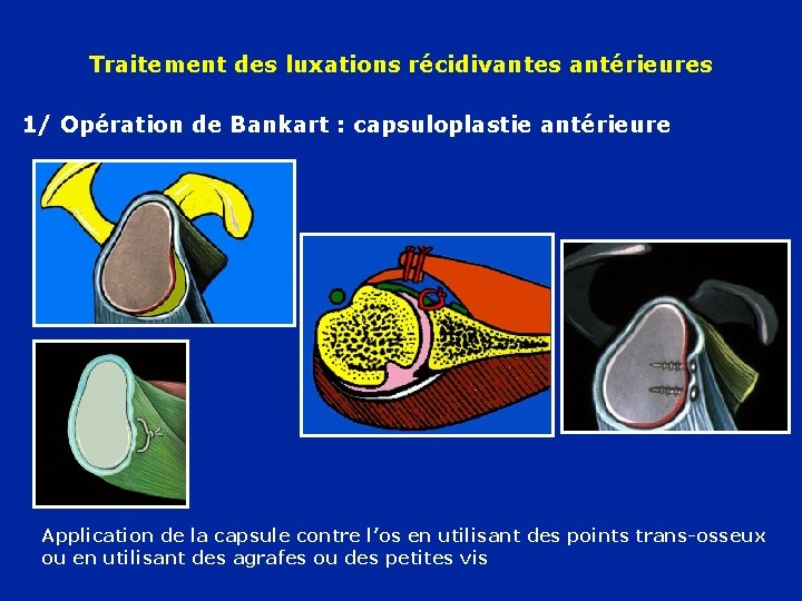 Traitement des luxations récidivantes antérieures 1/ Opération de Bankart : capsuloplastie antérieure Application de