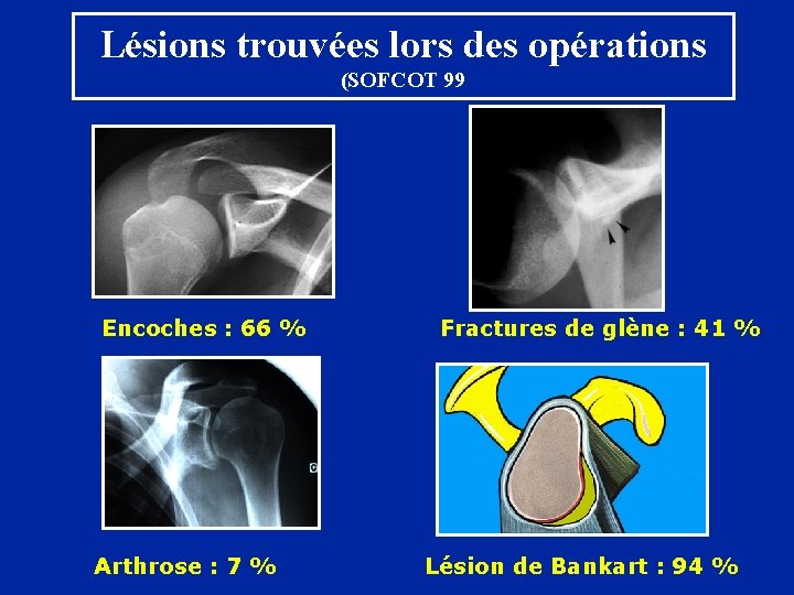 Lésions trouvées lors des opérations (SOFCOT 99 Encoches : 66 % Arthrose : 7