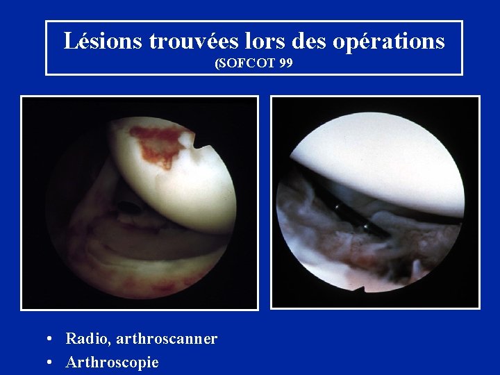 Lésions trouvées lors des opérations (SOFCOT 99 • Radio, arthroscanner • Arthroscopie 