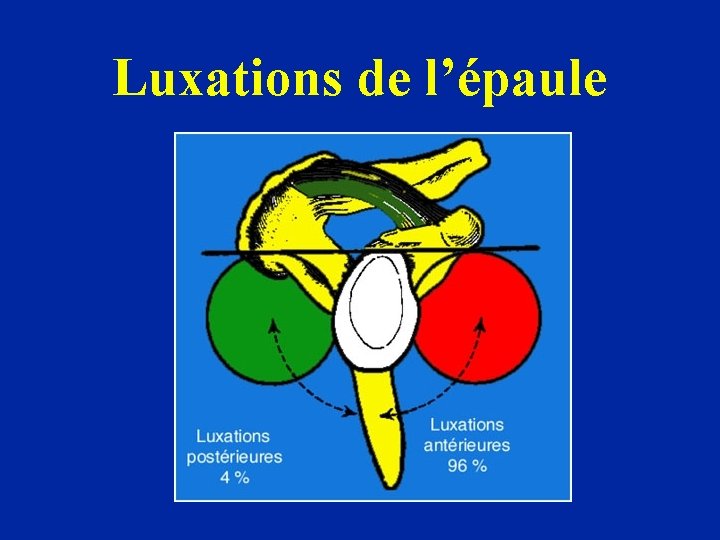 Luxations de l’épaule 