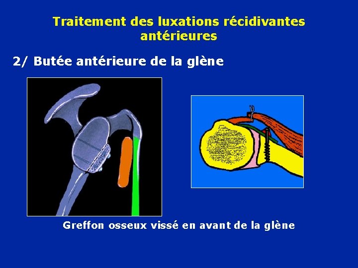 Traitement des luxations récidivantes antérieures 2/ Butée antérieure de la glène Greffon osseux vissé