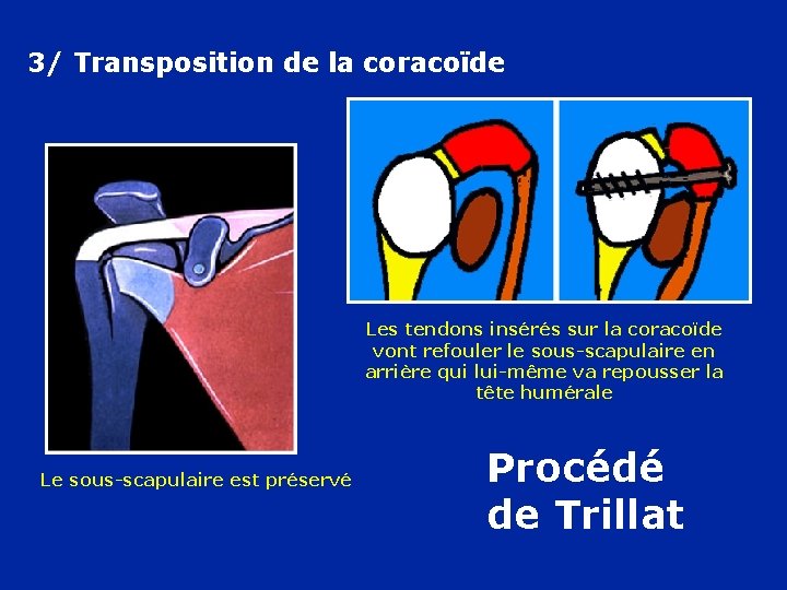 3/ Transposition de la coracoïde Les tendons insérés sur la coracoïde vont refouler le