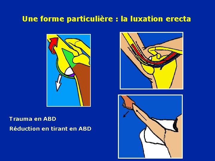 Une forme particulière : la luxation erecta Trauma en ABD Réduction en tirant en