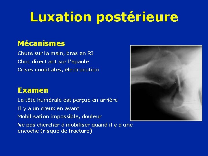 Luxation postérieure Mécanismes Chute sur la main, bras en RI Choc direct ant sur