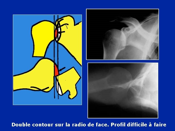 Double contour sur la radio de face. Profil difficile à faire 