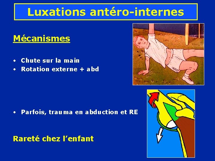 Luxations antéro-internes Mécanismes • Chute sur la main • Rotation externe + abd •