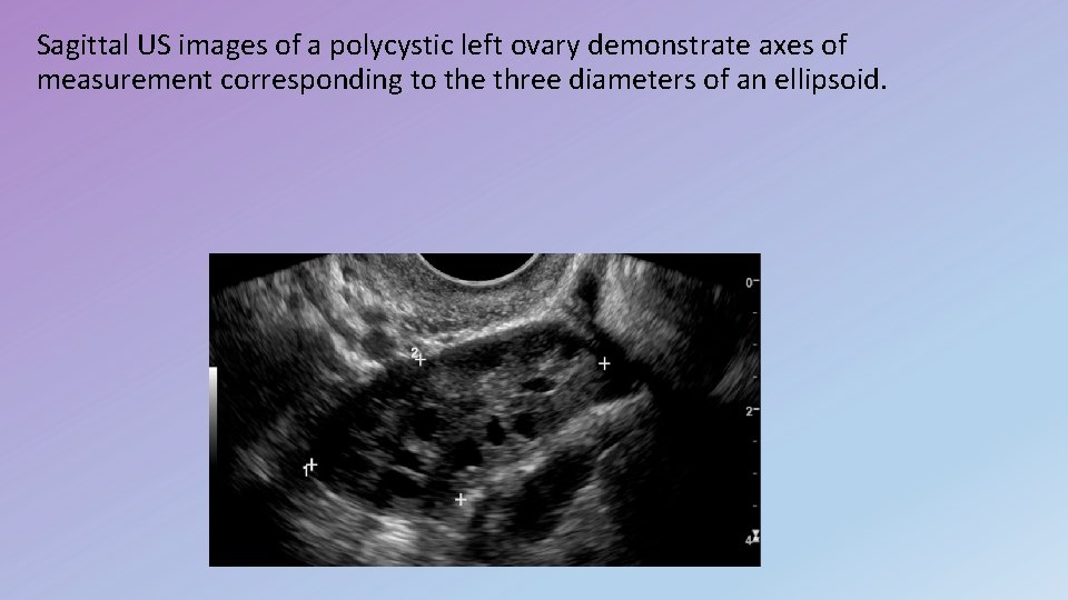 Sagittal US images of a polycystic left ovary demonstrate axes of measurement corresponding to