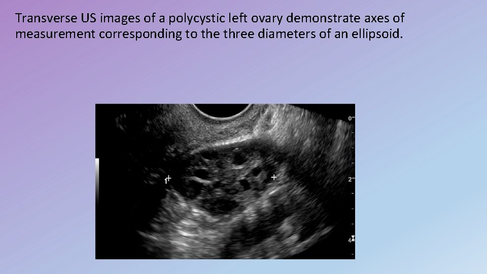 Transverse US images of a polycystic left ovary demonstrate axes of measurement corresponding to