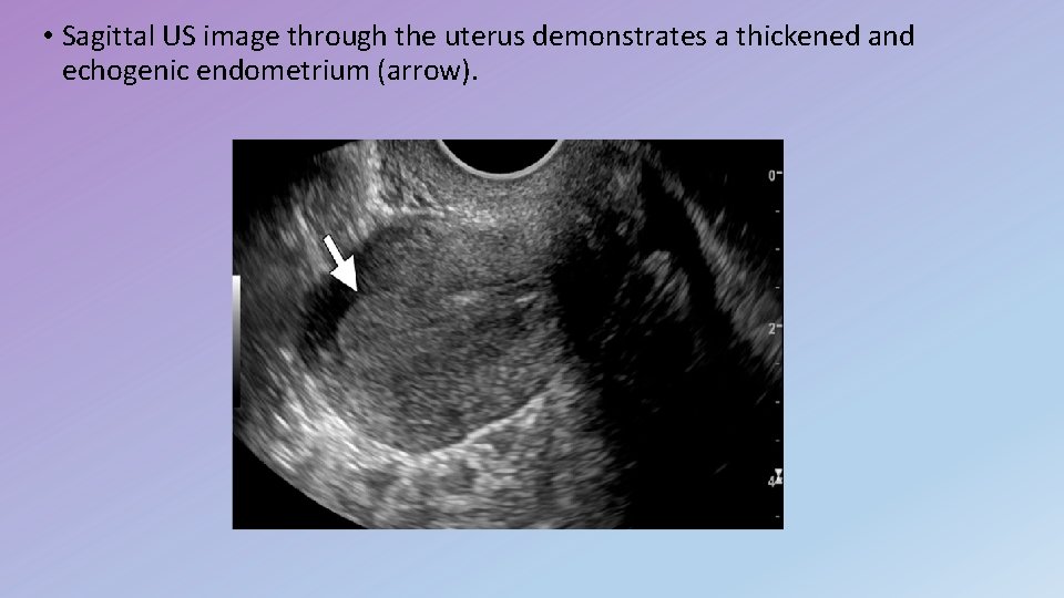  • Sagittal US image through the uterus demonstrates a thickened and echogenic endometrium