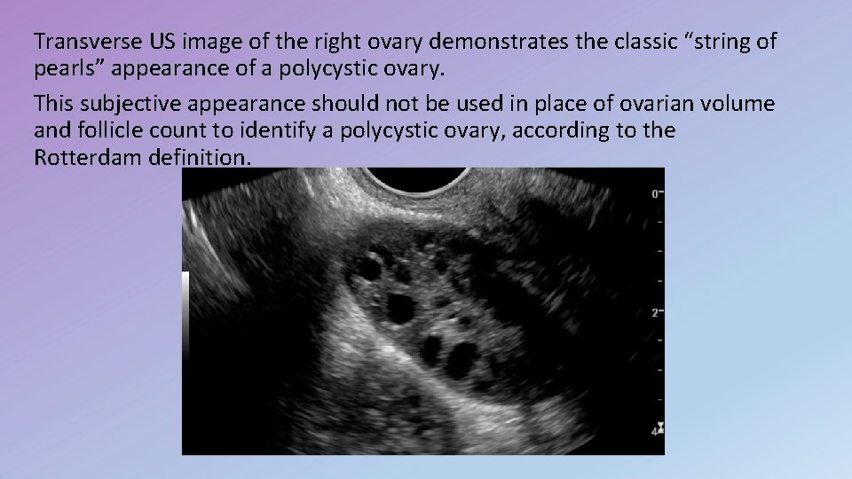 Transverse US image of the right ovary demonstrates the classic “string of pearls” appearance