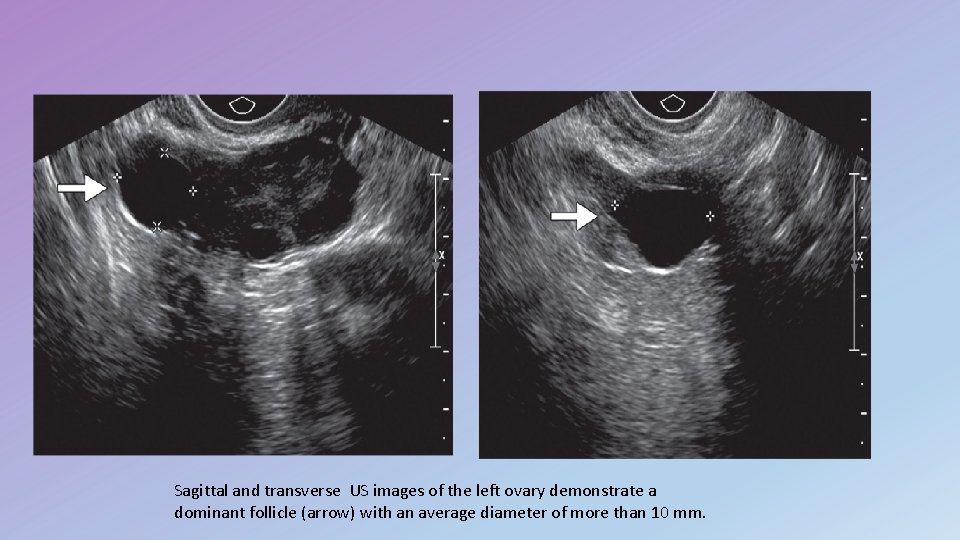 Sagittal and transverse US images of the left ovary demonstrate a dominant follicle (arrow)