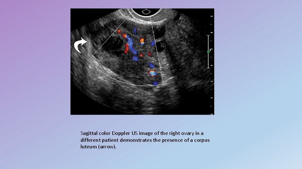 Sagittal color Doppler US image of the right ovary in a different patient demonstrates