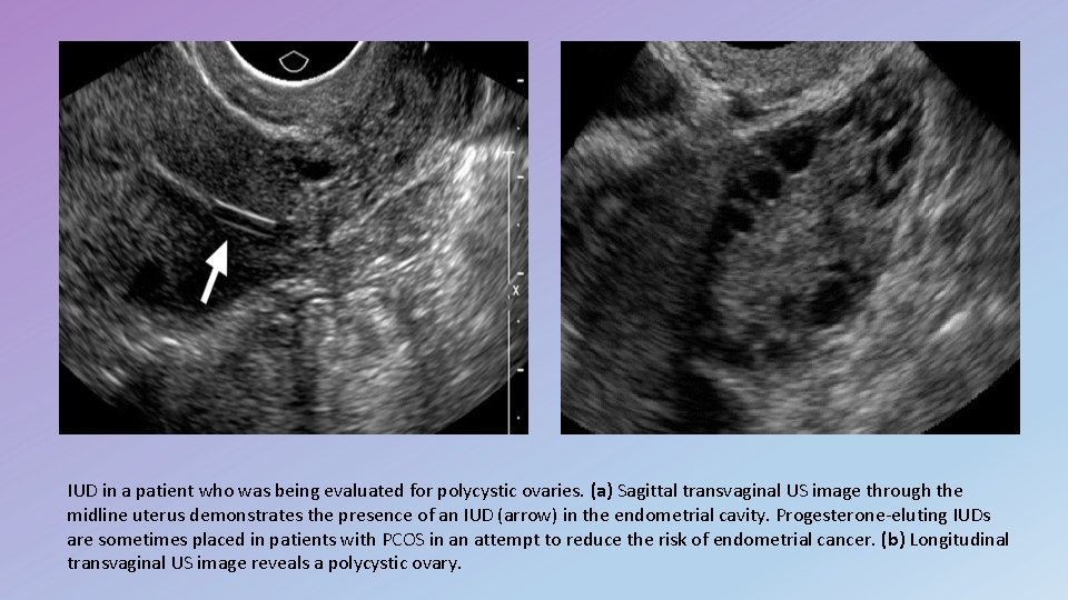 IUD in a patient who was being evaluated for polycystic ovaries. (a) Sagittal transvaginal