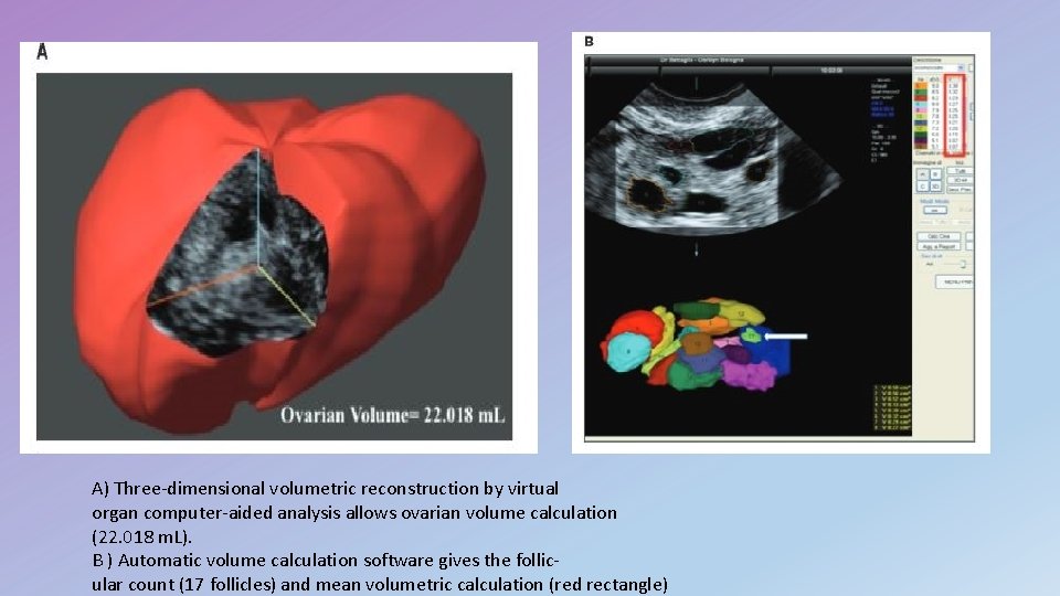 A) Three-dimensional volumetric reconstruction by virtual organ computer-aided analysis allows ovarian volume calculation (22.