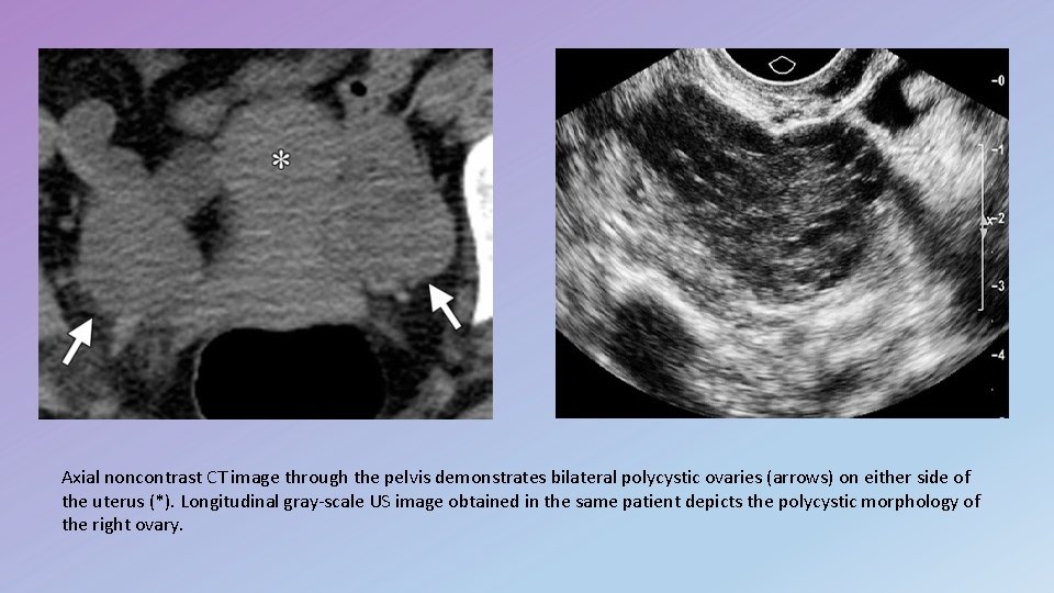 Axial noncontrast CT image through the pelvis demonstrates bilateral polycystic ovaries (arrows) on either