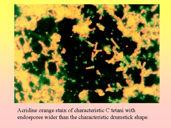 Acridine orange stain of characteristic C tetani with endospores wider than the characteristic drumstick