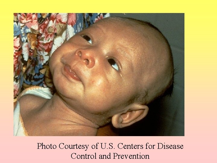 Photo Courtesy of U. S. Centers for Disease Control and Prevention 