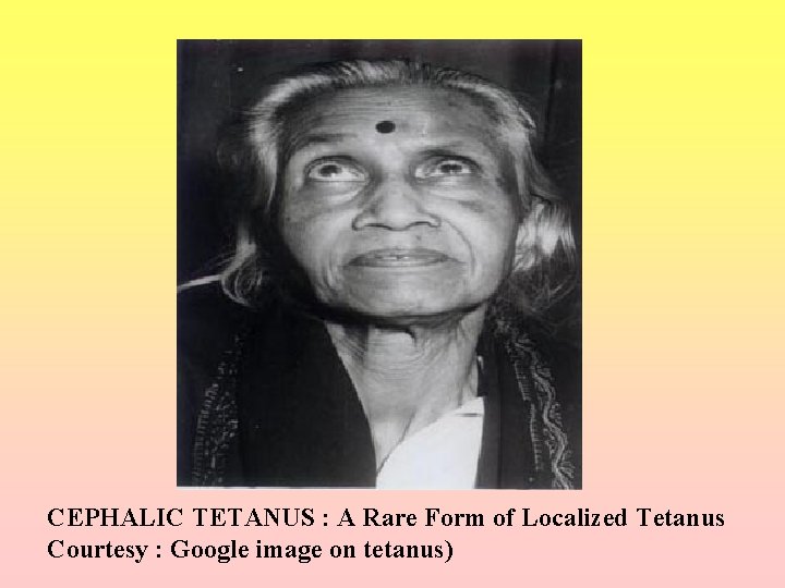 CEPHALIC TETANUS : A Rare Form of Localized Tetanus Courtesy : Google image on