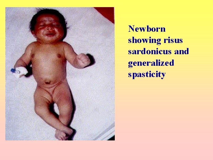 Newborn showing risus sardonicus and generalized spasticity 