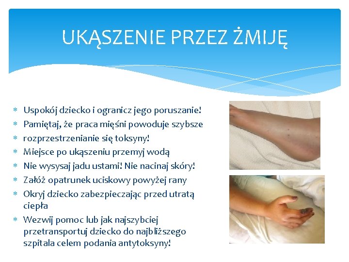 UKĄSZENIE PRZEZ ŻMIJĘ Uspokój dziecko i ogranicz jego poruszanie! Pamiętaj, że praca mięśni powoduje